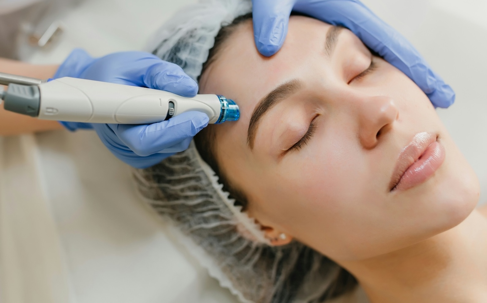 Microneedling