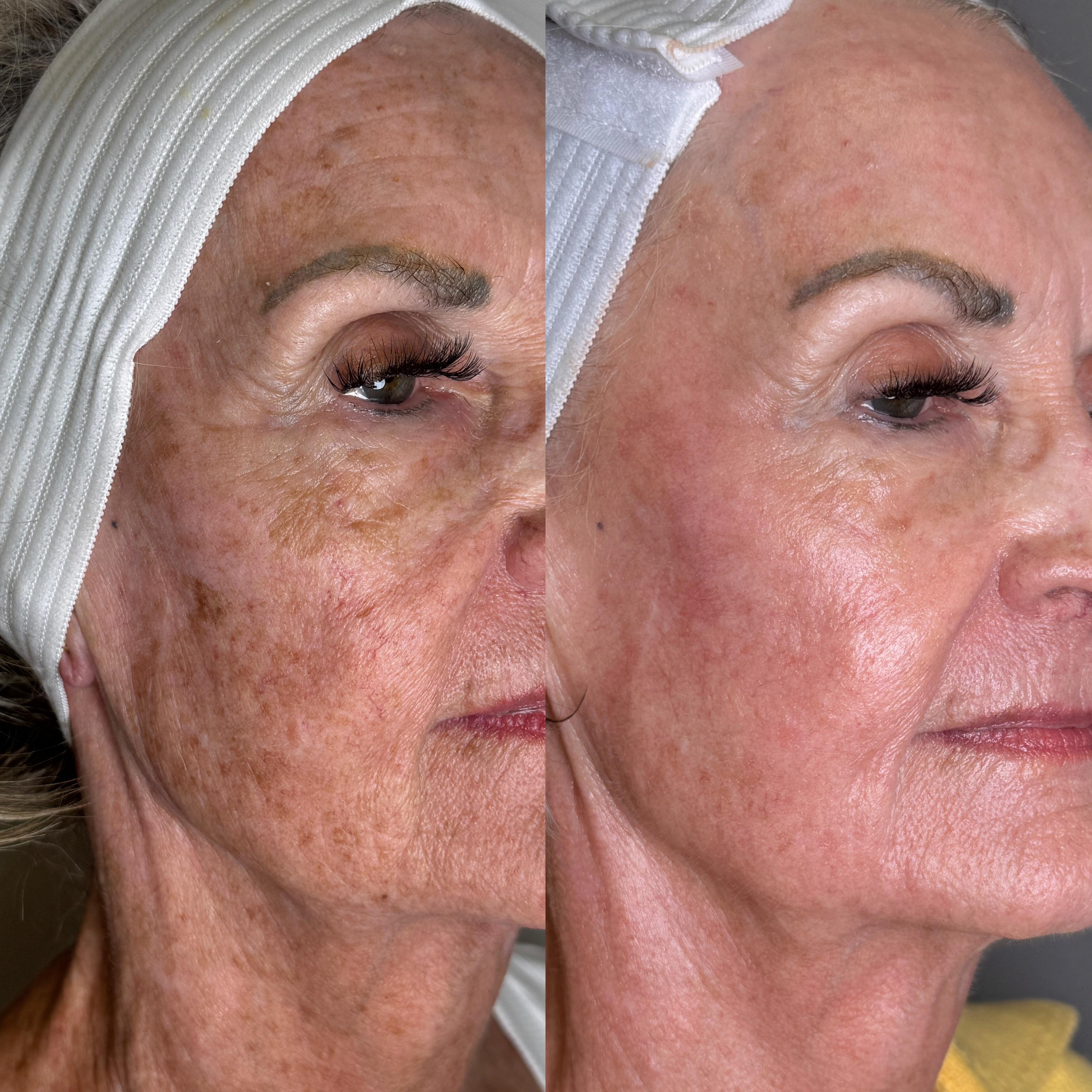 Treatment result photo