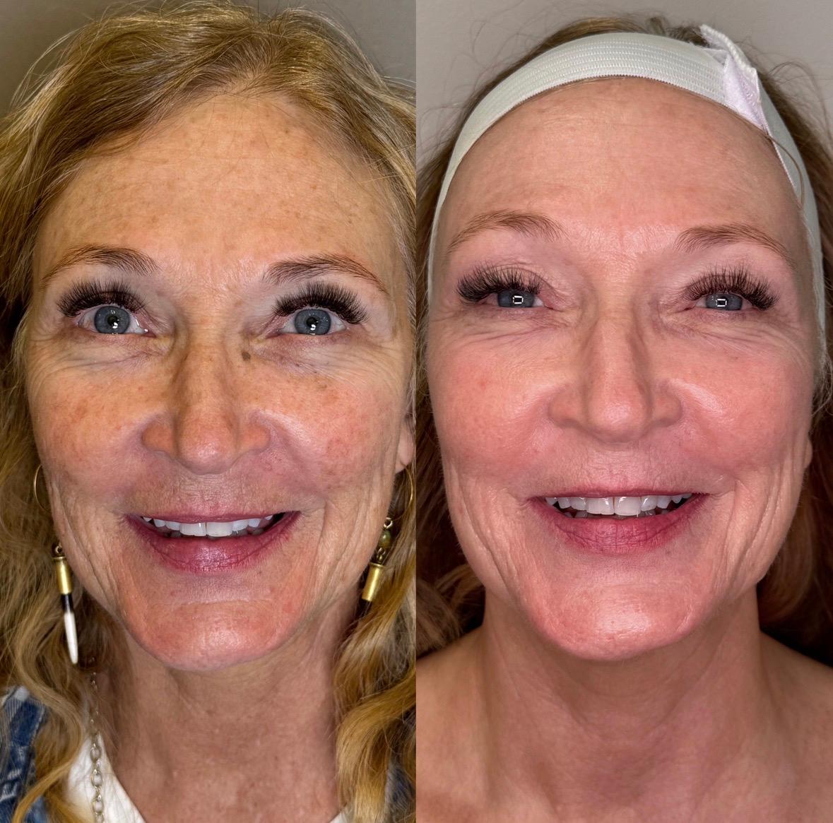 Treatment result photo