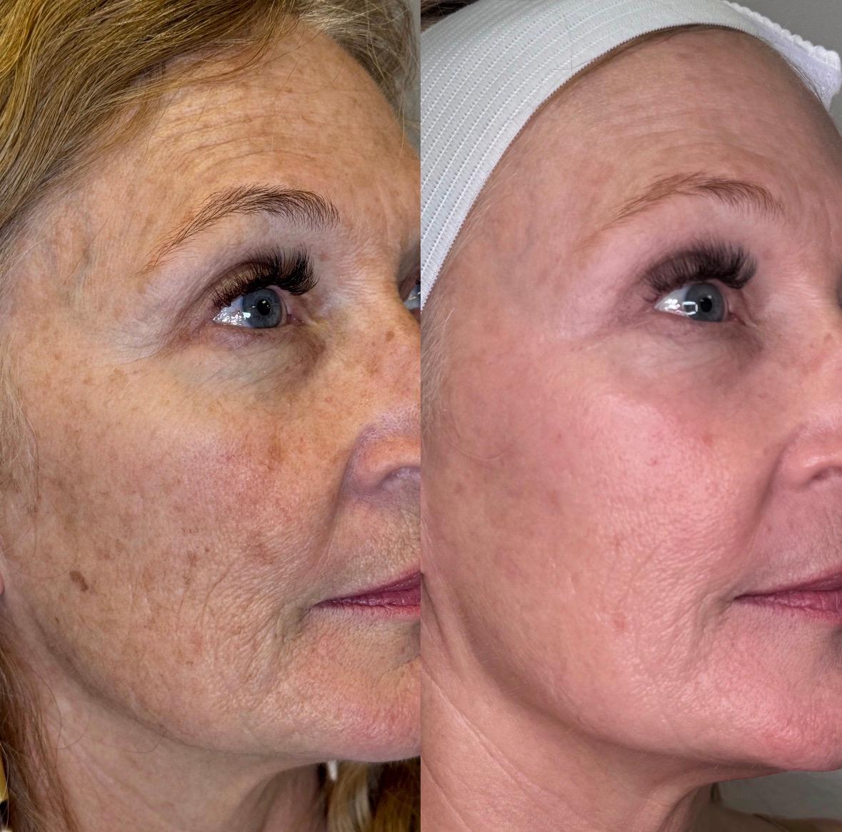 Treatment result photo
