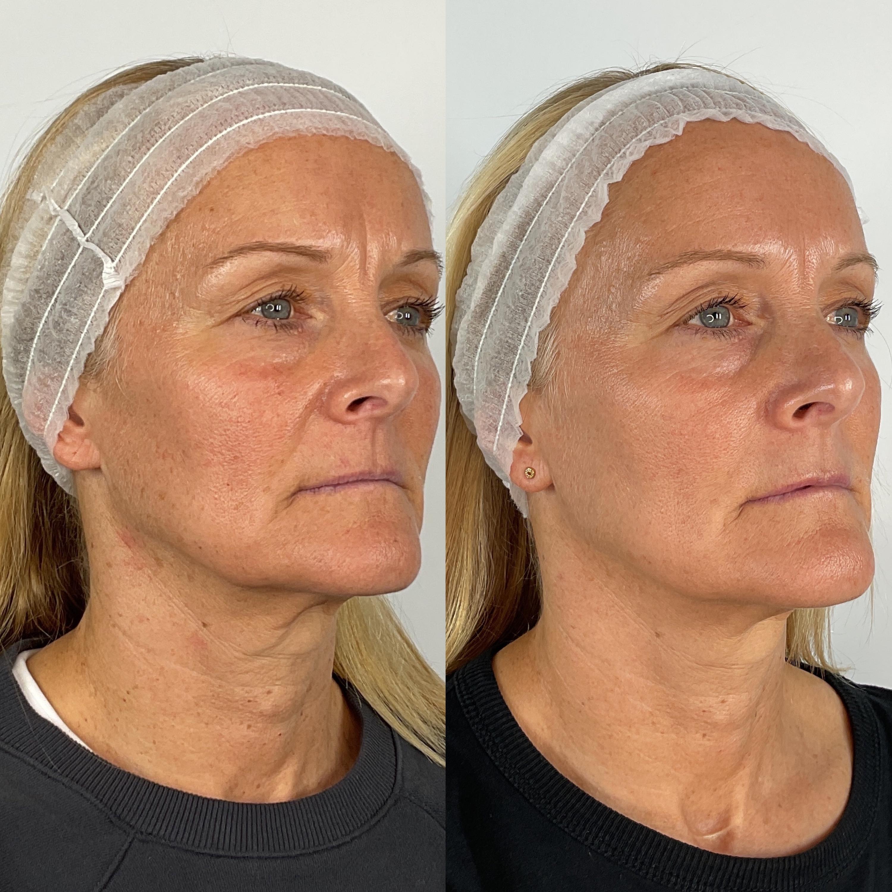 Treatment result photo