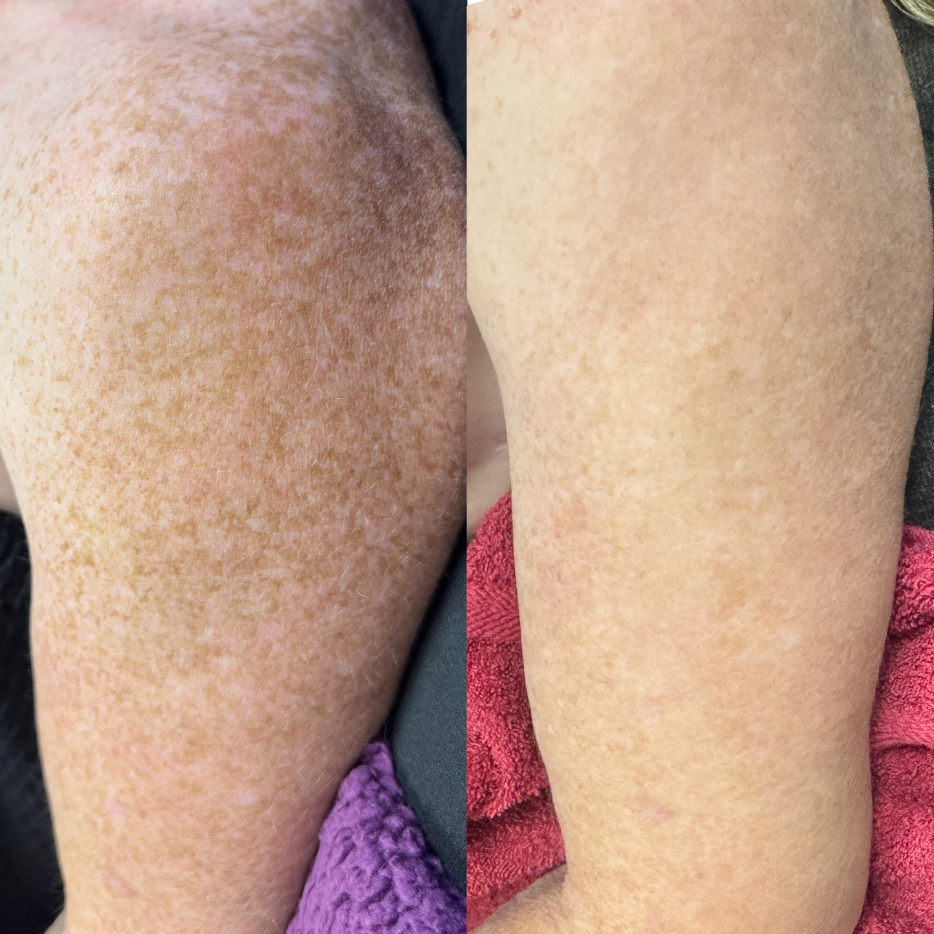 Treatment result photo