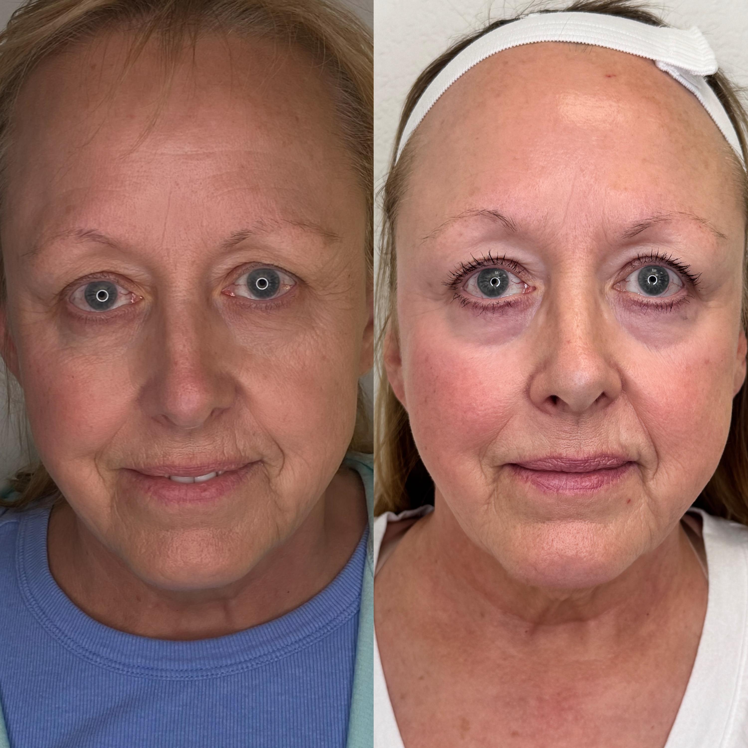 Treatment result photo