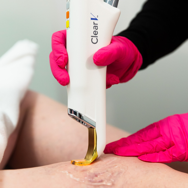 ClearV®