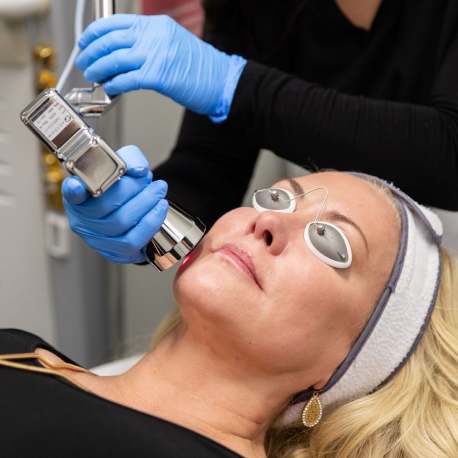MicroLaserPeel®